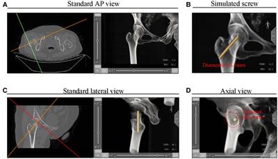 A new posterosuperior screw placement strategy to avoid in-out-in screws in femoral neck fractures